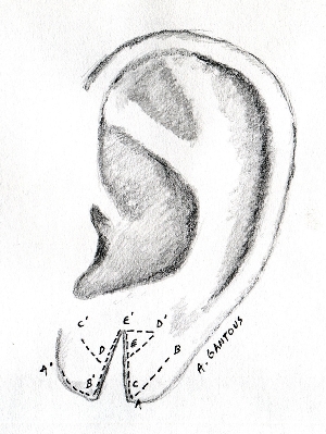 Реконструкция мочки уха